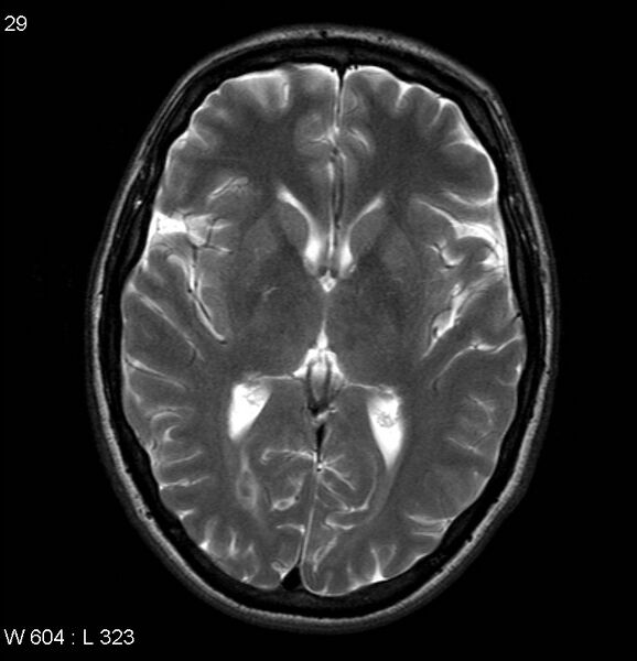File:Neurosarcoidosis (Radiopaedia 10930-17204 Axial T2 10).jpg