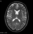 Neurosarcoidosis (Radiopaedia 10930-17204 Axial T2 11).jpg