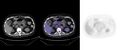 Non-Hodgkin lymphoma involving seminal vesicles with development of interstitial pneumonitis during Rituximab therapy (Radiopaedia 32703-33752 ax CT Fus PET 35).jpg