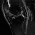 Non-displaced patella fracture (Radiopaedia 15932-15582 Sagittal T2 fat sat 10).jpg