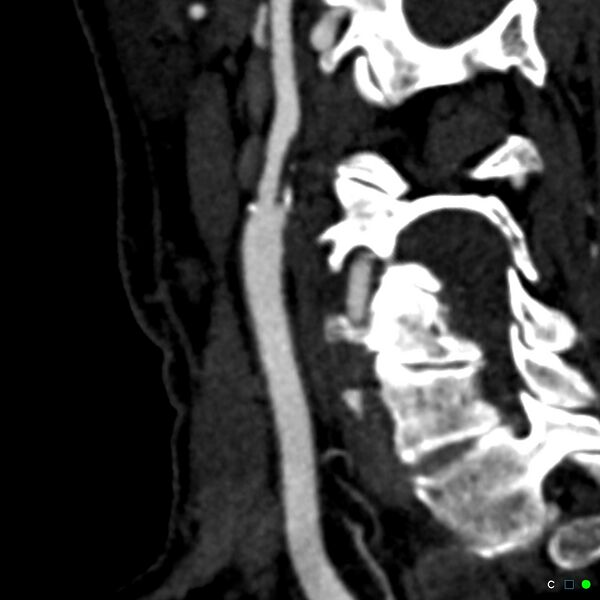 File:Non-occlusive intraluminal internal carotid artery thrombus (Radiopaedia 37751-39658 C 43).jpg