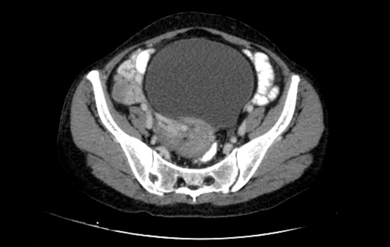 File:Non-puerperal uterine inversion (Radiopaedia 78343-91094 A 1).jpg