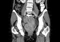 Non-puerperal uterine inversion (Radiopaedia 78343-91094 B 16).jpg