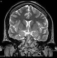 Normal coronal brain (Radiopaedia 6676-7910 Coronal T2 18).jpg