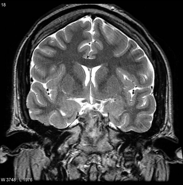 File:Normal coronal brain (Radiopaedia 6676-7910 Coronal T2 18).jpg