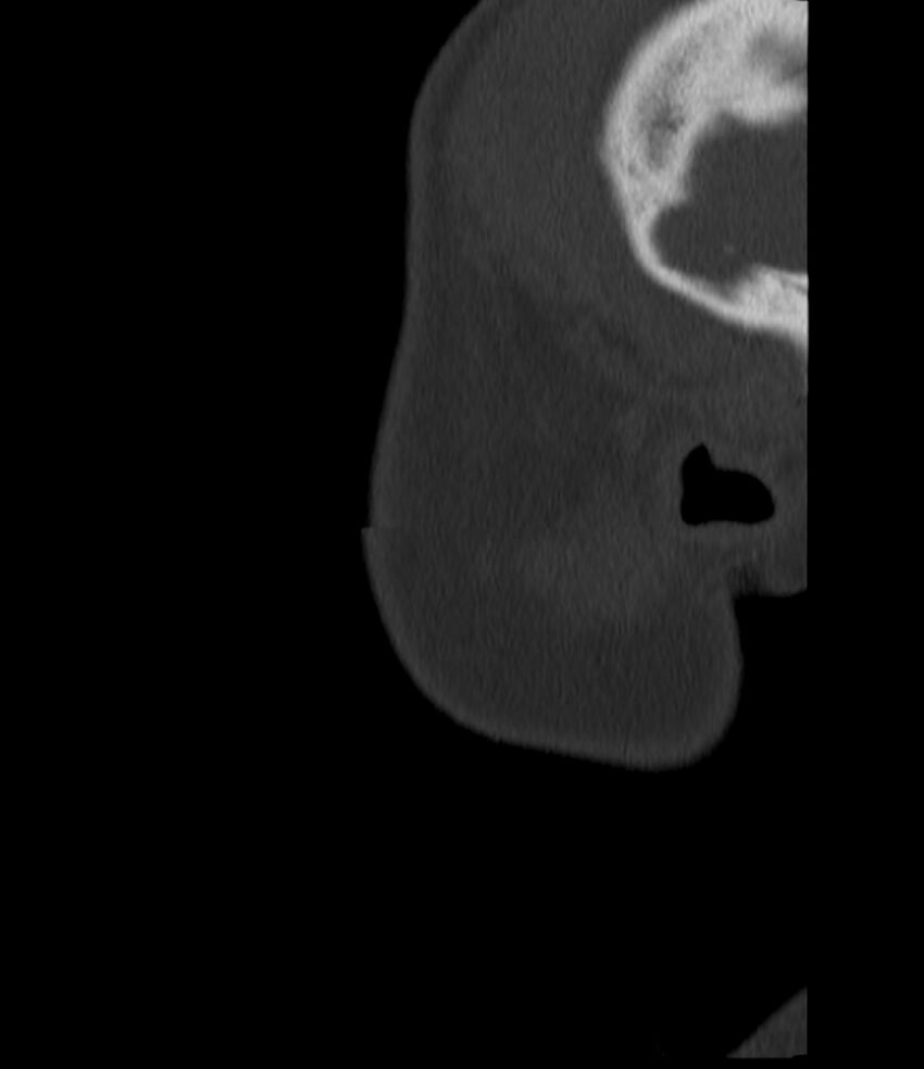 Normal facial bone CT (Radiopaedia 88742-105476 Sagittal bone window 16).jpg