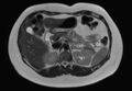 Normal liver MRI with Gadolinium (Radiopaedia 58913-66163 Axial T2 18).jpg