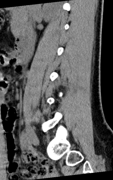 File:Normal lumbar spine CT (Radiopaedia 46533-50986 C 70).png