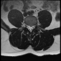 Normal lumbar spine MRI (Radiopaedia 35543-37039 Axial T2 16).png