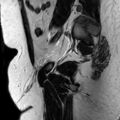 Normal prostate (MRI) (Radiopaedia 29986-30535 Sagittal T2 1).jpg