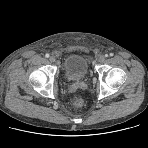 File:Obstructive bladder transitional cell carcinoma (Radiopaedia 9825-10410 A 33).jpg