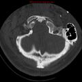 Occipital condyle fracture (Radiopaedia 18366-18208 Axial bone window 12).jpg