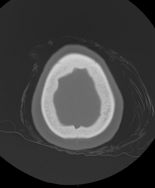 File:Occipital condyle fracture (Radiopaedia 61165-69056 Axial bone window 3).jpg