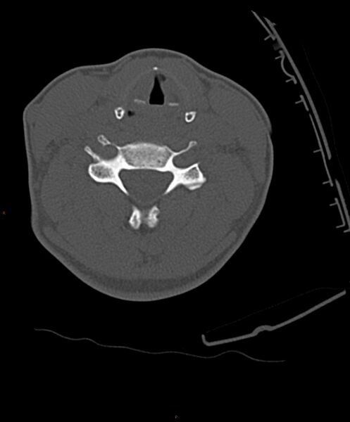 File:Occipital condyle fracture (Radiopaedia 61165-69056 D 18).jpg