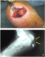 Salvage therapy with Daptomycin for osteomyelitis- a)Ulcerative lesion of right heel b) Standard Rx scan of right heel