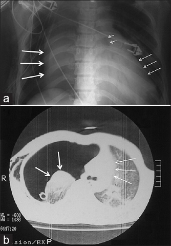 a)Collapsed right lung , left deviated trachea , and shifted heart b) chest illustrating collapsed right lung and shifted heart