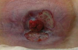 Peristomal ulceration and redness persisted nearly 10 years despite conventional therapy.