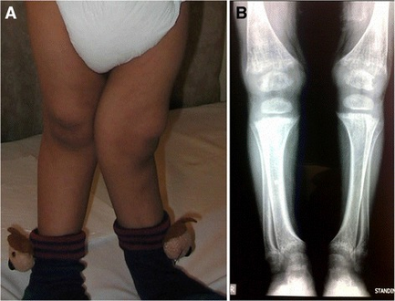 Rickets in cystinosis. a- A cystinosis child with evident rachitic bone deformities. b- Active rachitic bone disease in X-Rays