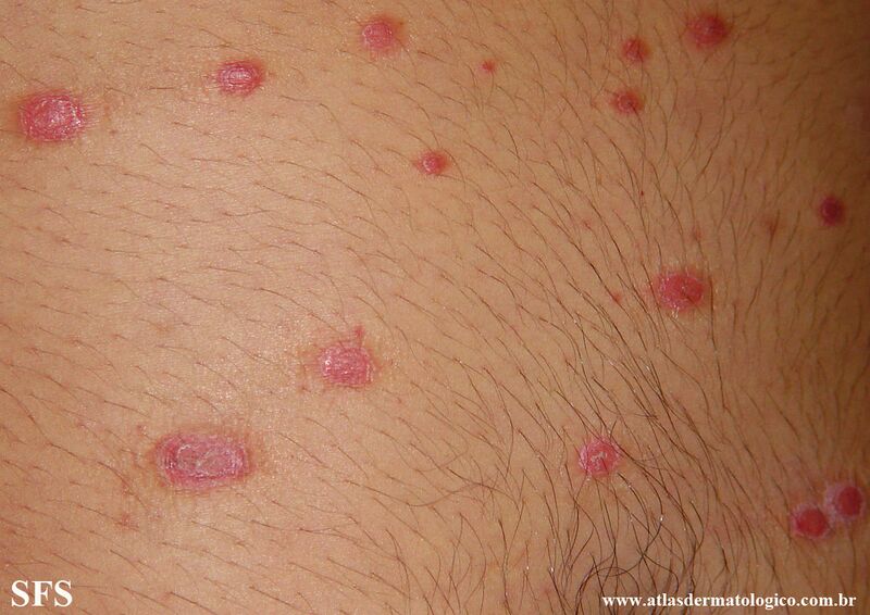File:Psoriasis (Dermatology Atlas 147).jpg