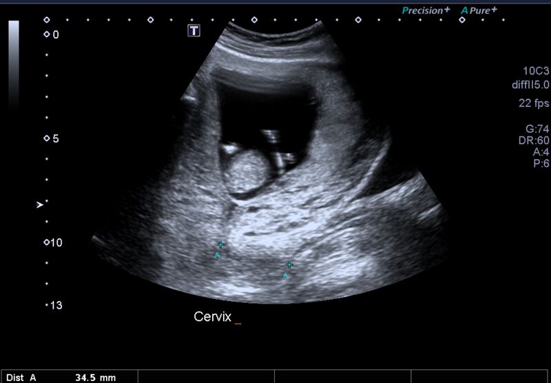File:1st trimester nuchal-morphology ultrasound (Radiopaedia 44706-48477 General anatomy and NT 48).jpg