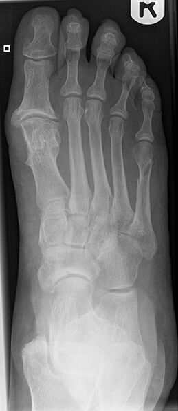 File:5th metatarsal fracture (Radiopaedia 6378-7738 Frontal 1).jpg
