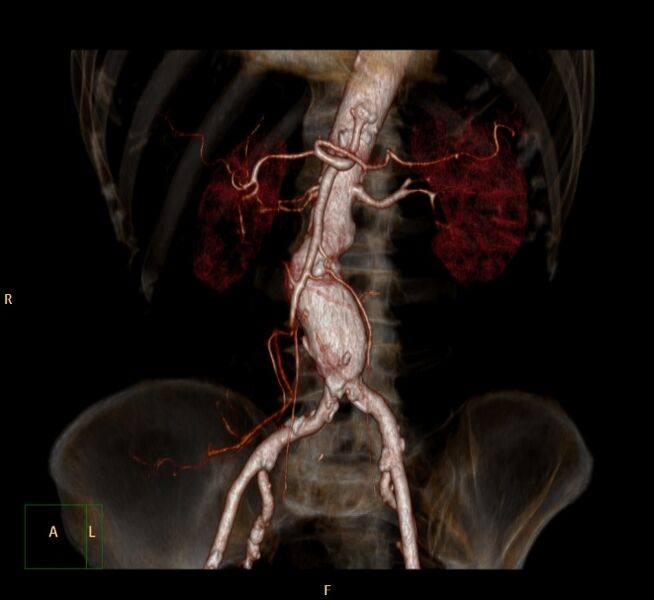 File:Abdominal aortic aneurysm (Radiopaedia 23703-23856 3D 25).jpg