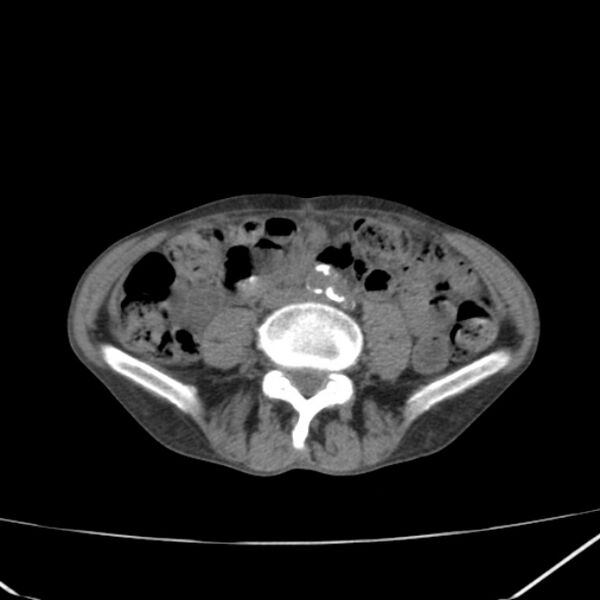 File:Abdominal aortic aneurysm (Radiopaedia 23703-23856 Axial non-contrast 33).jpg