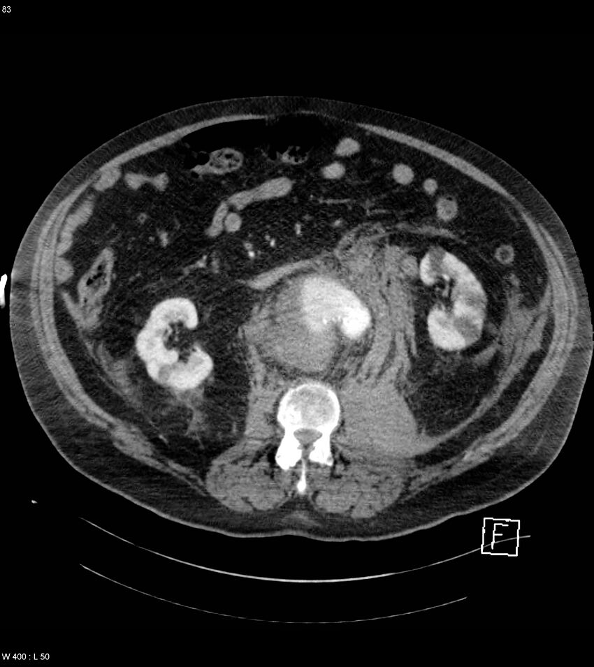 Abdominal aortic aneurysm with intramural hematoma then rupture (Radiopaedia 50278-55632 Axial C+ arterial phase 82).jpg