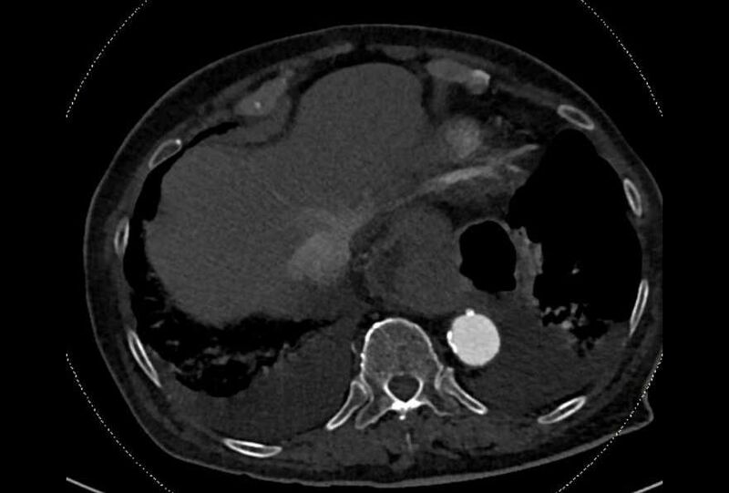 File:Abdominal aortic aneurysm with thrombus fissuration (Radiopaedia 73192-83919 Axial C+ arterial phase 1).jpg