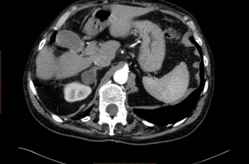File:Abdominal aortic interposition tube graft and aneurysm thrombosis (Radiopaedia 71438-81857 Axial C+ arterial phase 11).jpg