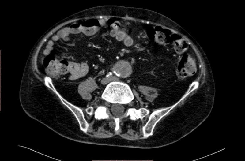 File:Abdominal aortic interposition tube graft and aneurysm thrombosis (Radiopaedia 71438-81857 Axial C+ arterial phase 130).jpg