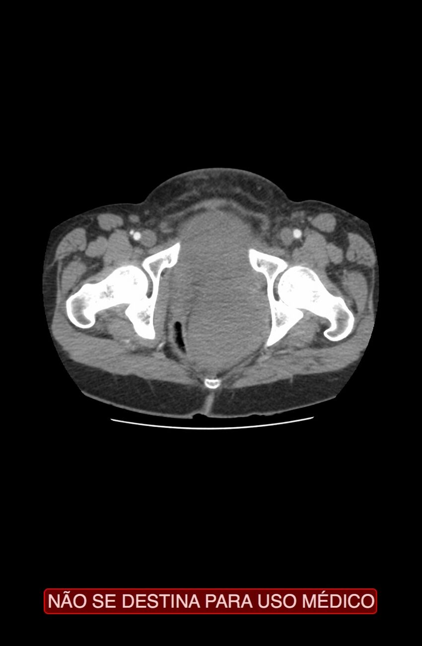 Abdominal desmoid tumor (Radiopaedia 44024-47540 Axial C+ arterial phase 53).jpg