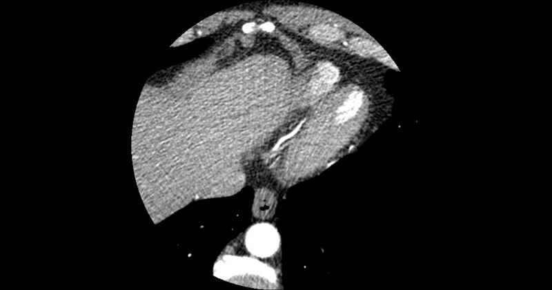 File:Aberrant left main coronary artery (ALMCA) arising from the right sinus with interarterial course (Radiopaedia 63251-71814 Axial C+ arterial phase 178).JPG