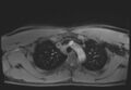 Active right ventricular cardiac sarcoidosis (Radiopaedia 55596-62100 Axial Post contrast Dixon 9).jpg