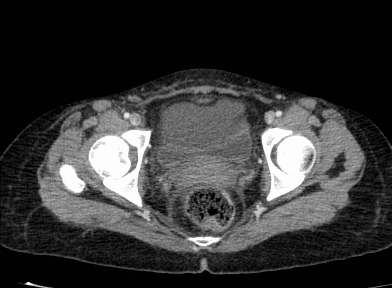 File:Acute Budd-Chiari syndrome (Radiopaedia 60858-68638 Axial C+ portal venous phase 281).jpg