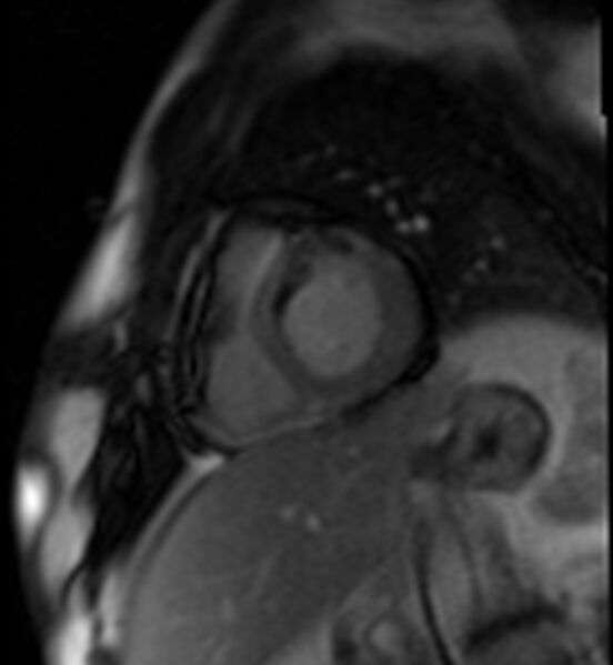 File:Acute anteroseptal myocardial infarction (Radiopaedia 68409-77945 Short axis (basal) Perfusion 31).jpg