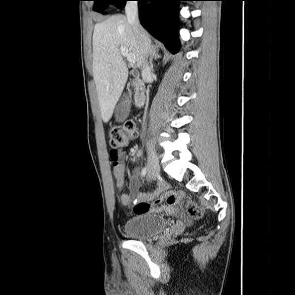 File:Acute appendicitis (Radiopaedia 27049-27227 Sagittal C+ portal venous phase 33).jpg