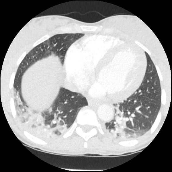 File:Acute chest syndrome - sickle cell disease (Radiopaedia 42375-45499 Axial lung window 138).jpg