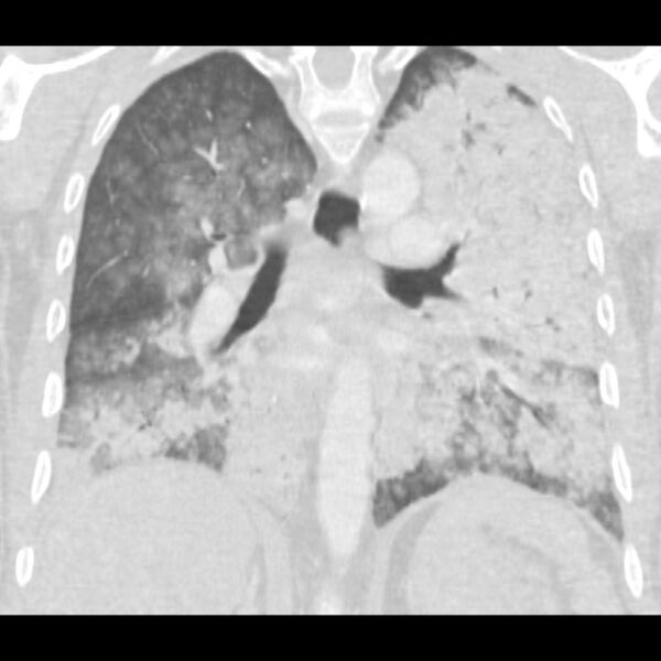 File:Acute diffuse alveolar hemorrhage (Radiopaedia 41323-44158 Coronal lung window 33).jpg