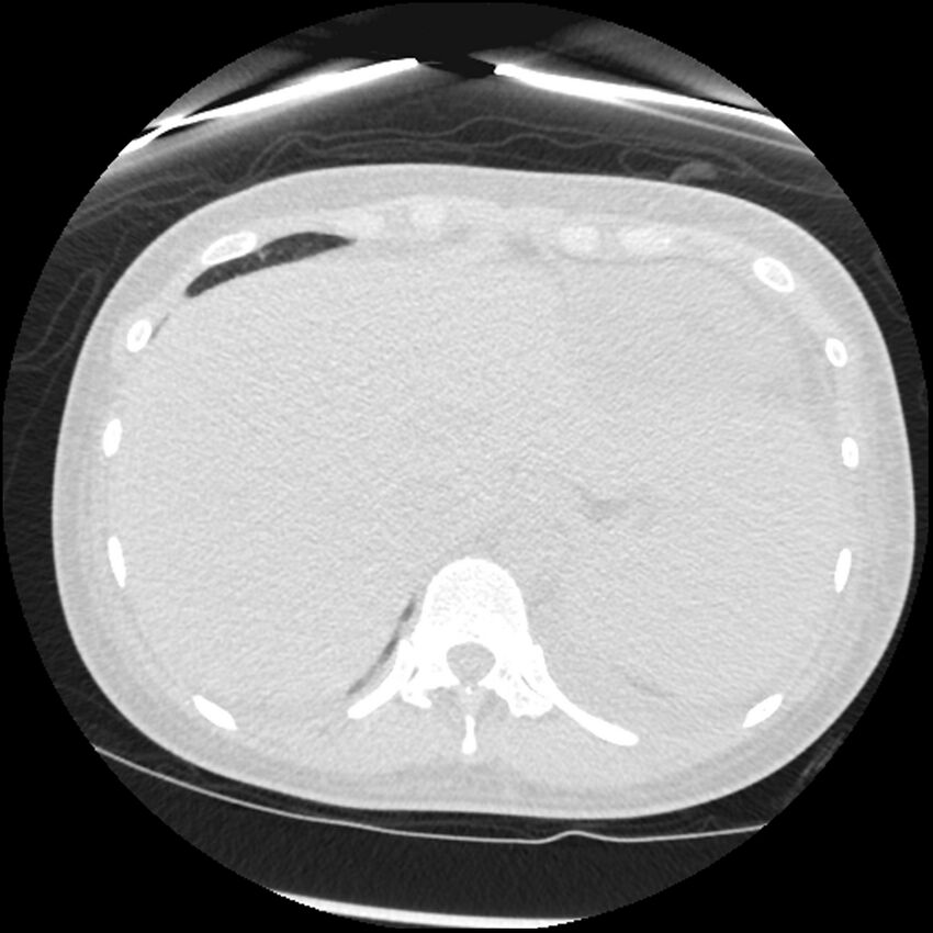 Acute lupus nephritis (Radiopaedia 45832-50107 Axial lung window 87).jpg