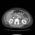 Acute myocarditis (Radiopaedia 55988-62613 Axial C+ portal venous phase 32).jpg