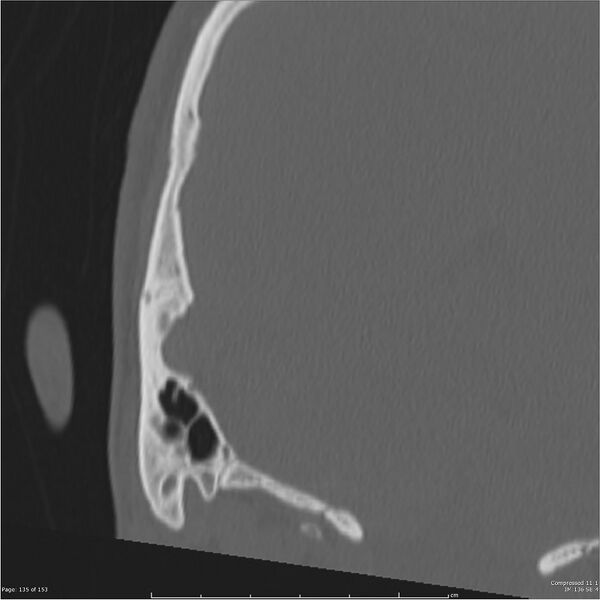 File:Acute otomastoiditis (Radiopaedia 28276-28512 Coronal PTB bone window reformat 66).jpg