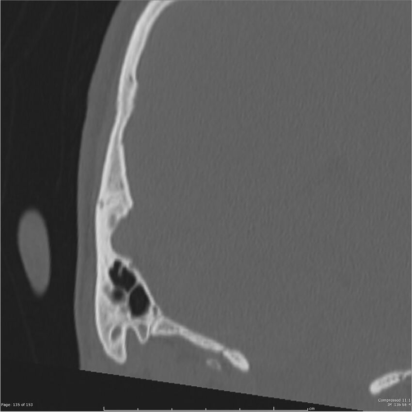 Acute otomastoiditis (Radiopaedia 28276-28512 Coronal PTB bone window reformat 66).jpg