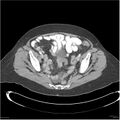 Acute pancreatitis (Radiopaedia 19136-19117 Axial C+ portal venous phase 37).jpg