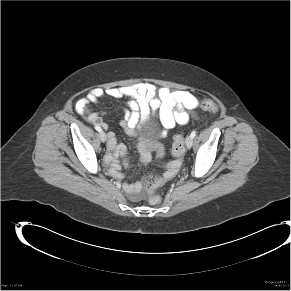 File:Acute pancreatitis (Radiopaedia 19136-19117 Axial C+ portal venous phase 37).jpg