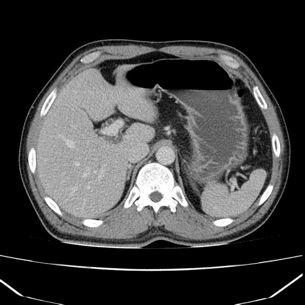File:Acute pancreatitis (Radiopaedia 22572-22596 Axial C+ portal venous phase 18).jpg