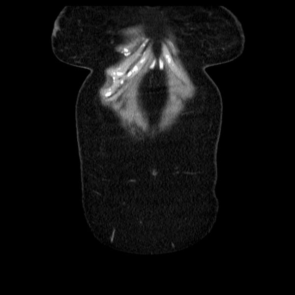 File:Acute pancreatitis - Balthazar C (Radiopaedia 26569-26714 Coronal C+ portal venous phase 11).jpg
