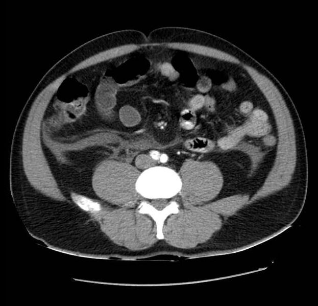 File:Acute pancreatitis - Balthazar E (Radiopaedia 23080-23110 Axial C+ arterial phase 43).jpg