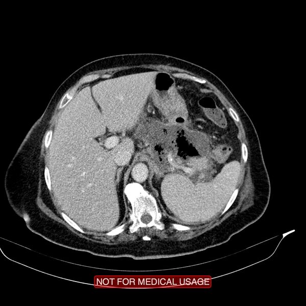 File:Acute pancreatitis with infected necrosis (Radiopaedia 26454-26585 Axial C+ portal venous phase 4).jpg