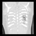Acute pulmonary edema on CT (Radiopaedia 33582-34672 Coronal lung window 35).jpg